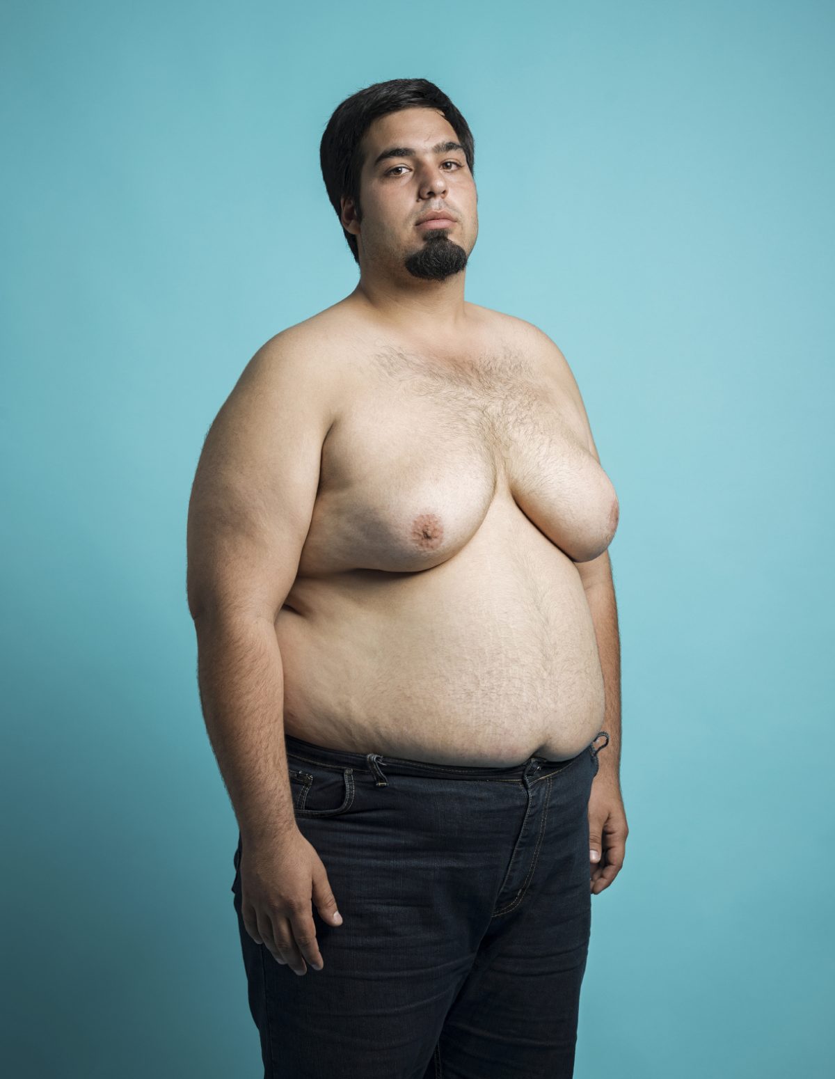 грудь у мужчин при ожирении фото 14